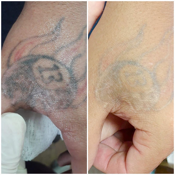 quantas sessões para remover tatuagem