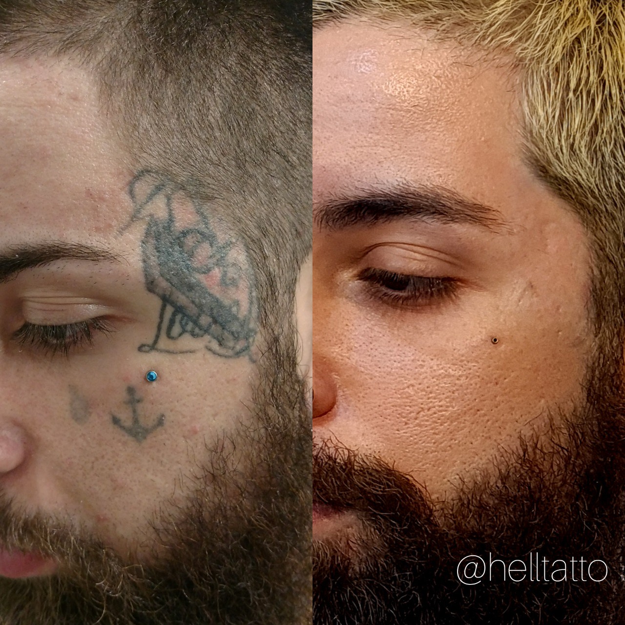melhor método para remover tatuagem