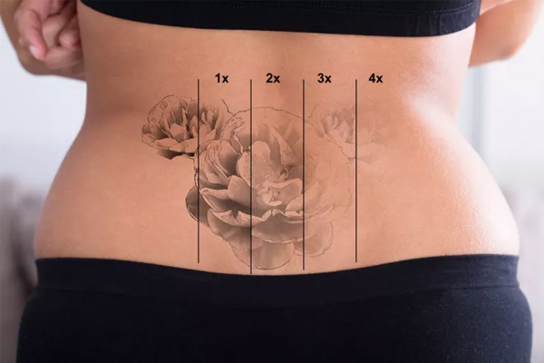 remoção de tatuagem colorida