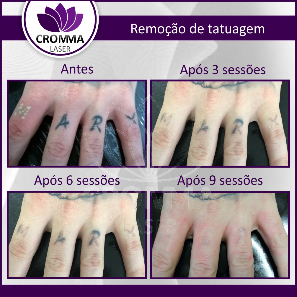 remoção de tatuagem preta