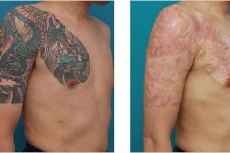 cicatriz após remoção de tatuagem