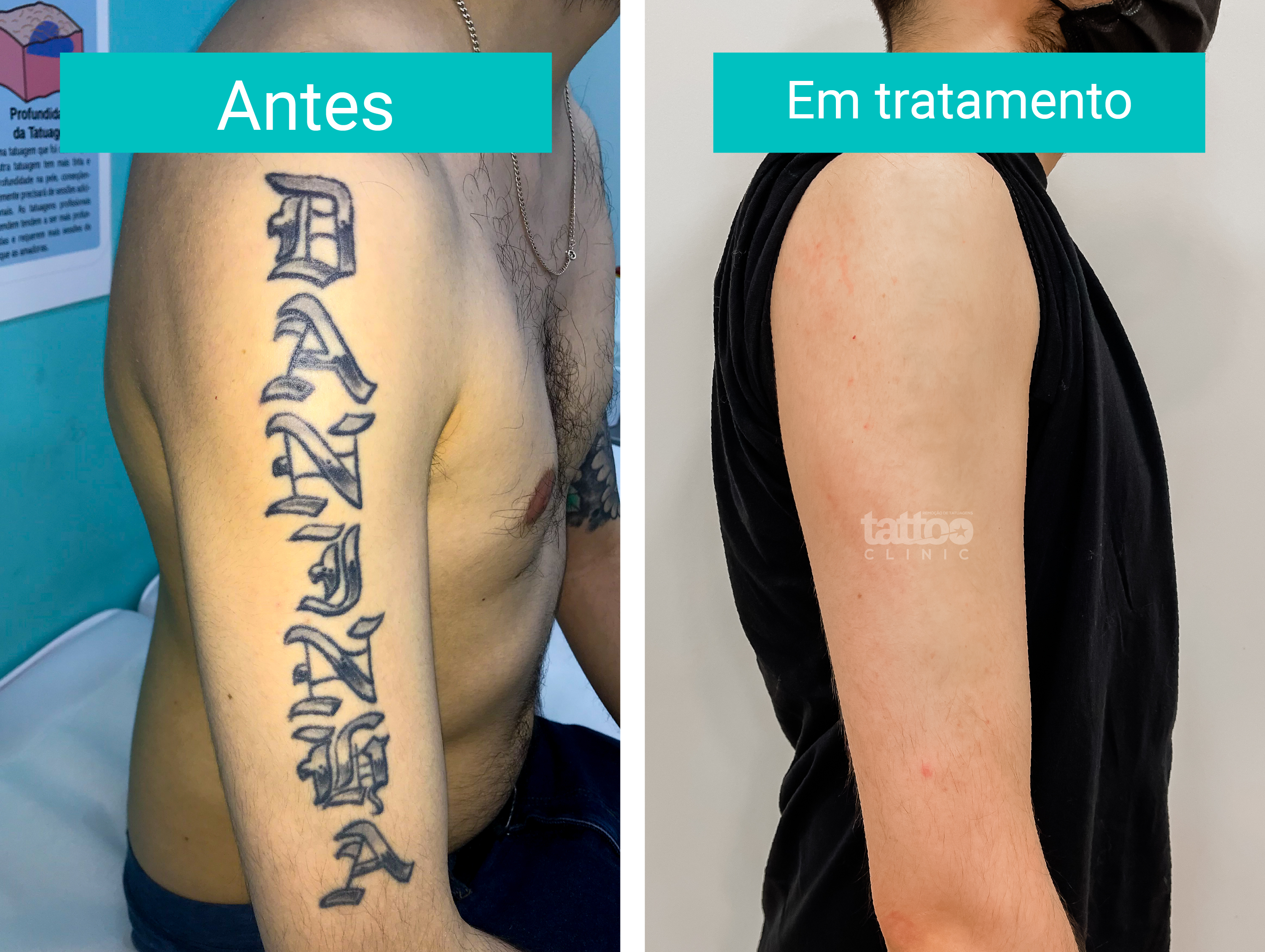 remoção de tatuagem recente vs antiga