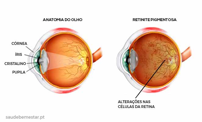 Perícia Médica do INSS para Retinose Pigmentar: O que esperar e como se preparar