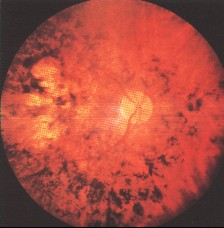 Projeto de Lei 1141/22: O Futuro da Aposentadoria para Retinose Pigmentar