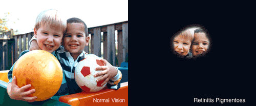 BPC/LOAS para Retinose Pigmentar: Quem tem direito e como solicitar