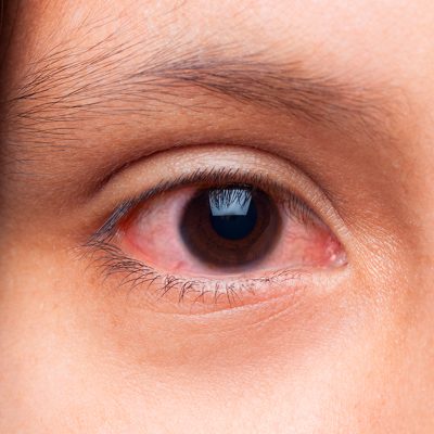 retinose pigmentar aposentadoria