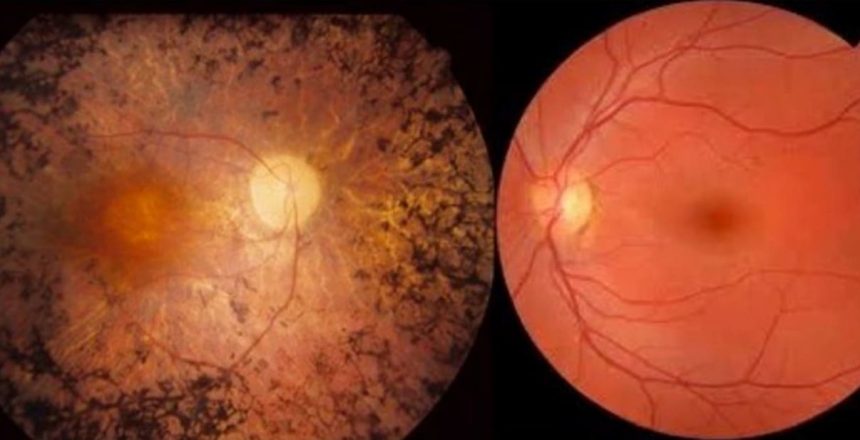 Retinose Pigmentar: Entenda o CID-10 H35.5 e Seus Direitos no INSS