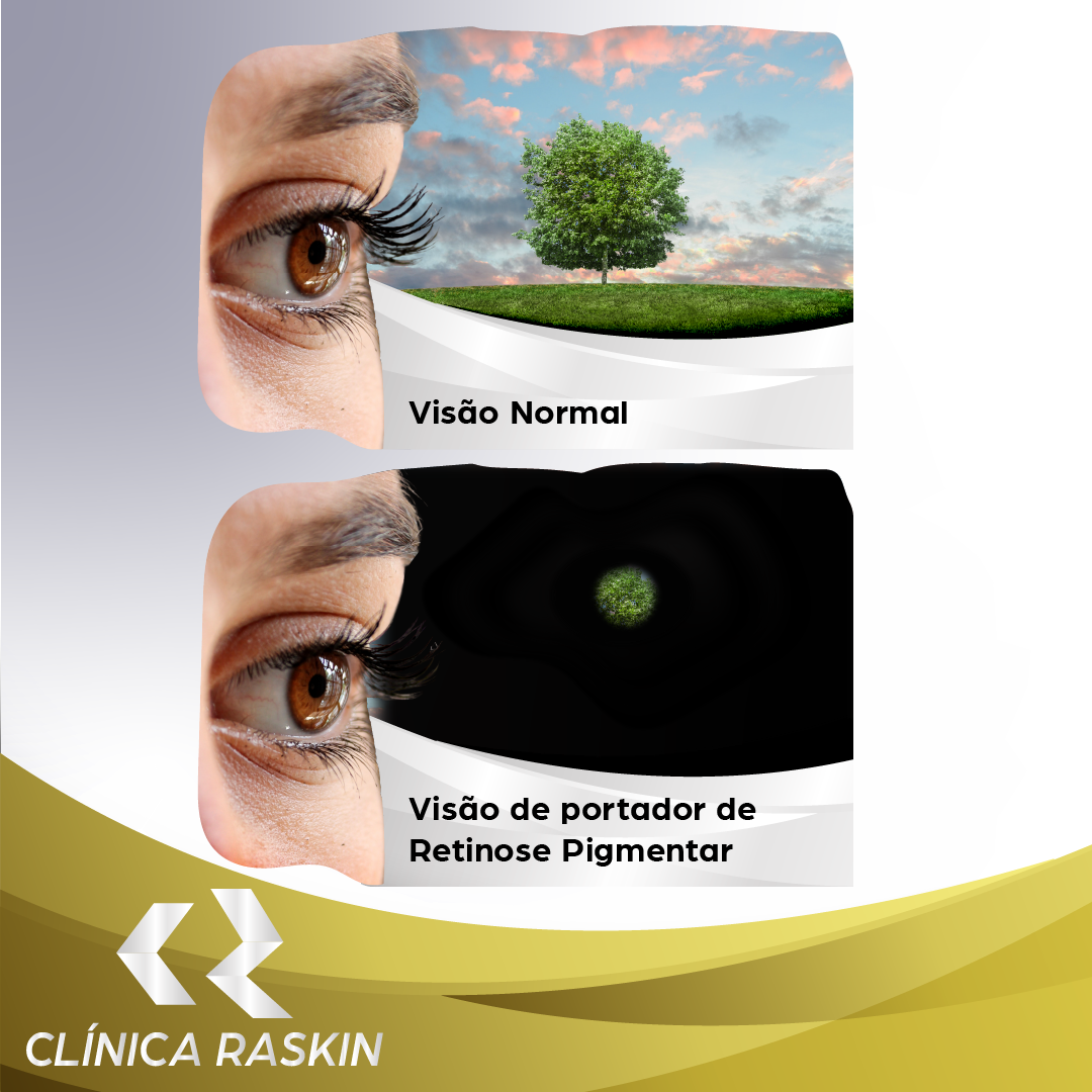 Guia Completo para Aposentadoria PcD por Retinose Pigmentar: Requisitos e Documentos