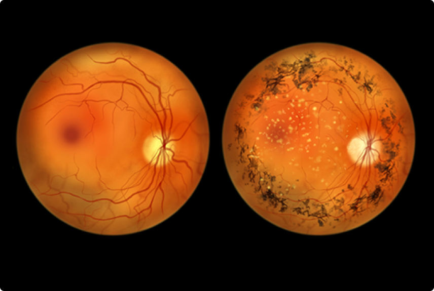 BPC/LOAS para Retinose Pigmentar: Quem tem direito e como solicitar