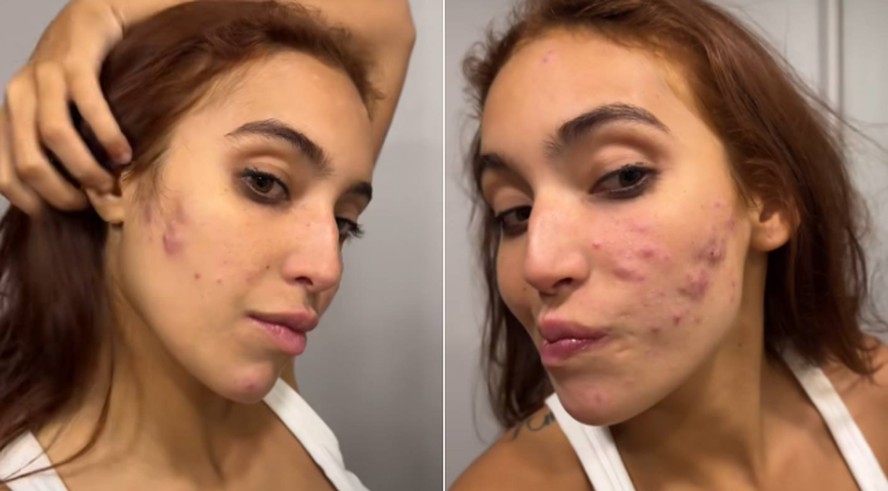 Guia completo sobre o tratamento com Roacutan