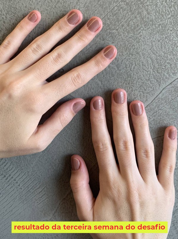 5 ideias de títulos:
1. Onicofagia: Entenda as Causas e os Riscos Ocultos de Roer Unhas
2. Guia Completo: Como Superar o Hábito de Roer Unhas de Vez
3. Roer Unhas: Sinais de Alerta para a Saúde Física e Mental
4. Terapia e Dicas Práticas para Combater a Onicofagia
5. A Psicologia por Trás de Roer Unhas: Ansiedade