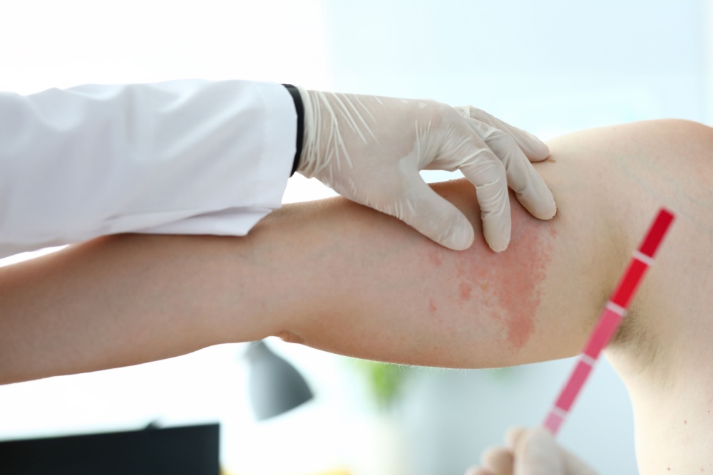 O que é a Infecção Aguda pelo HIV e seus Sintomas