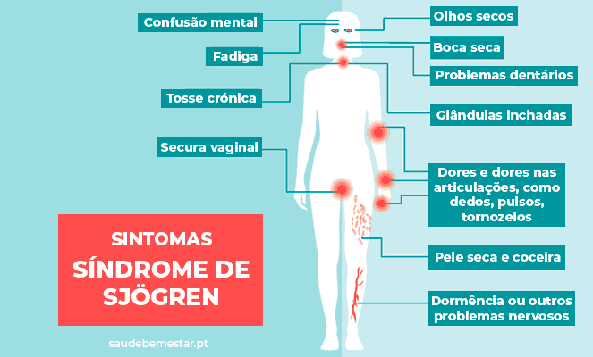 Sindrome De Sjogren Tem Cura