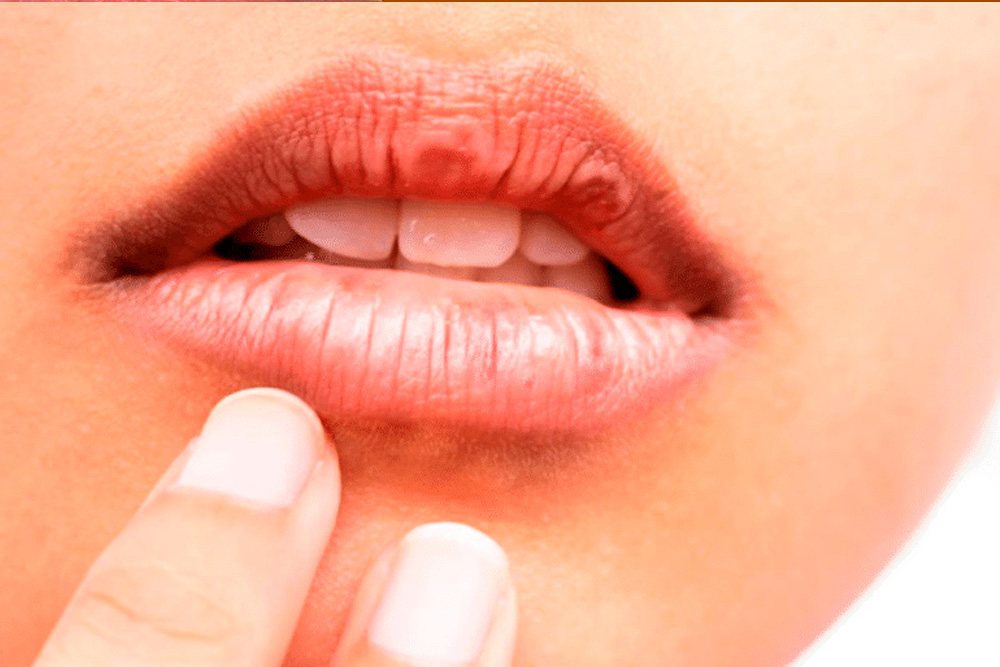 Sindrome De Sjogren Tem Cura