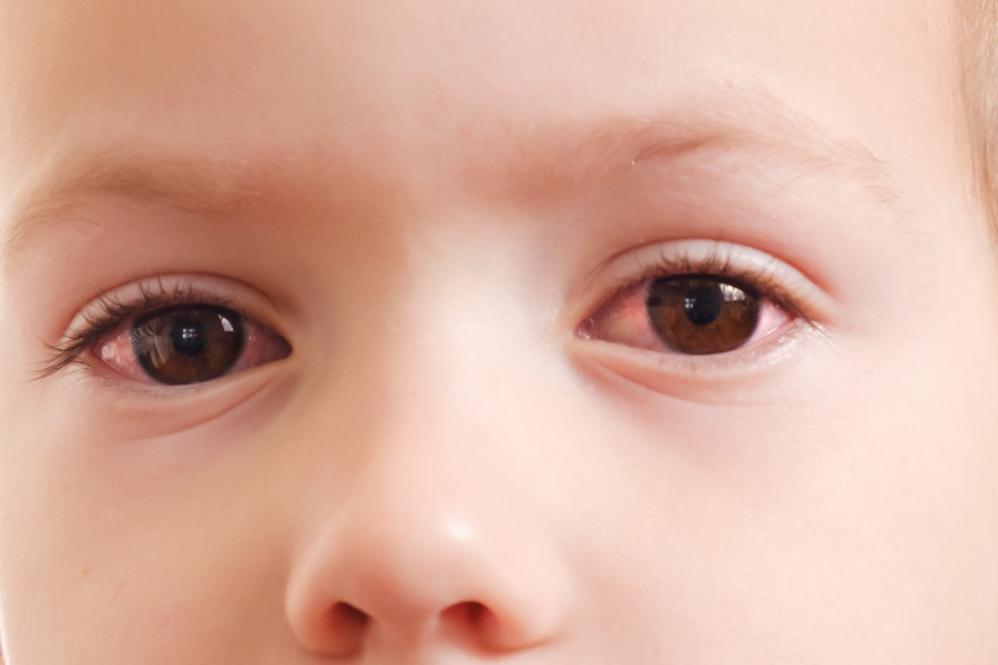 sintomas de conjuntivite infantil