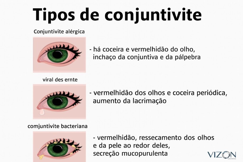 Guia completo: Como limpar os olhos do bebê com conjuntivite