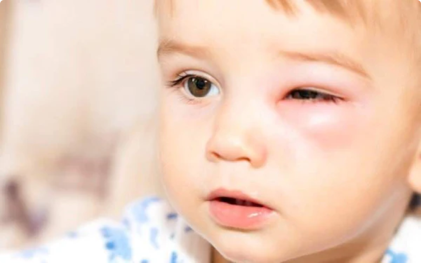 Conjuntivite em recém-nascidos: O que os pais precisam saber