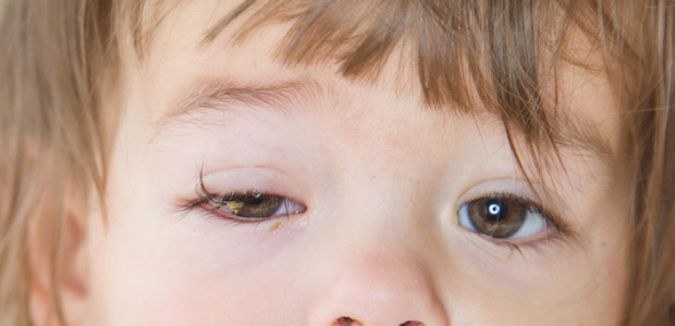 Guia completo: Como limpar os olhos do bebê com conjuntivite