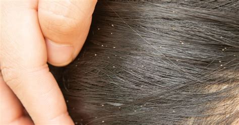 Sonhar com Piolho em Outra Pessoa: Entenda Suas Relações