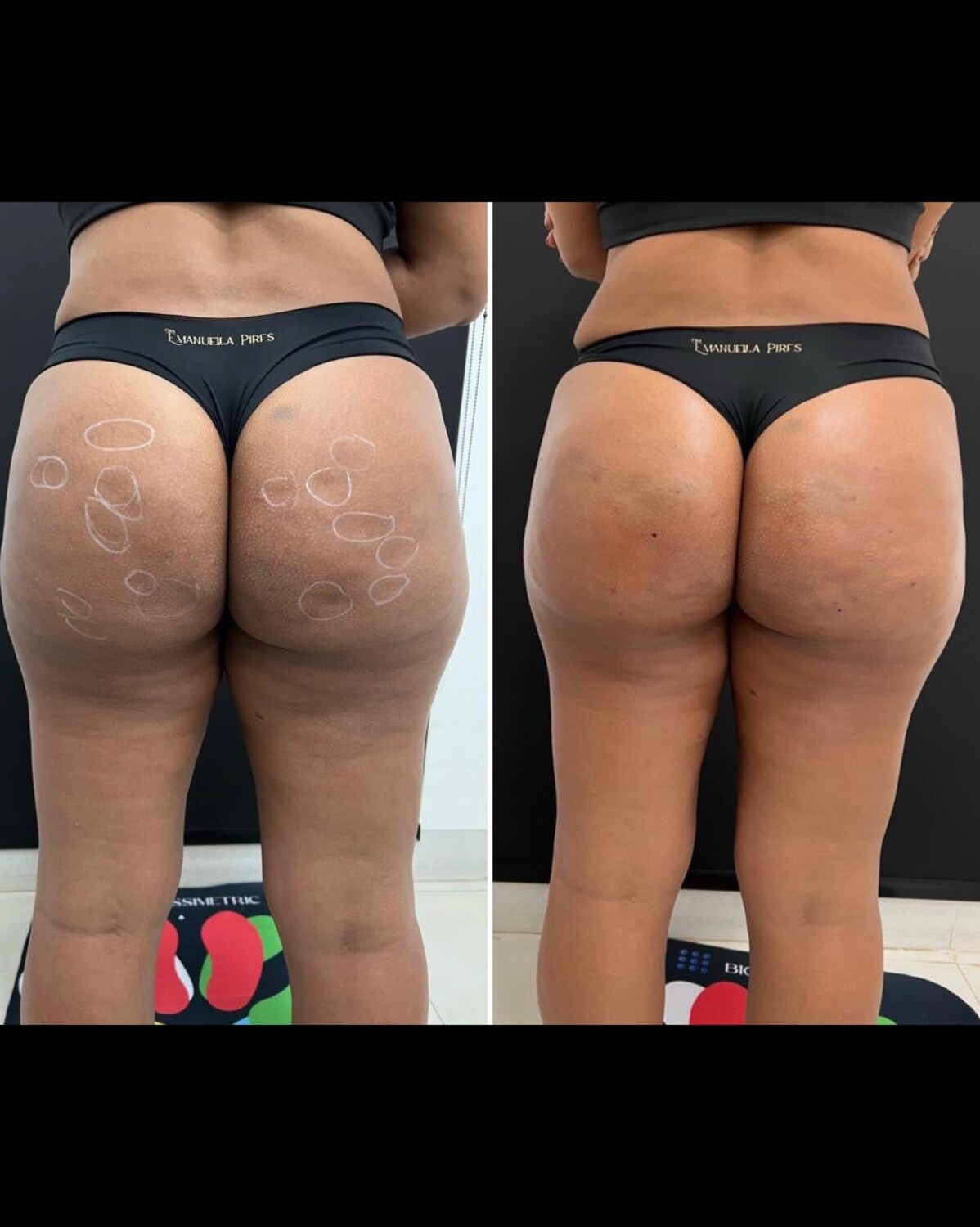 5 ideias de títulos:
1. Subcisão: O Guia Completo para Celulites e Cicatrizes
2. Antes e Depois da Subcisão: Resultados Reais
3. Recuperação Pós-Subcisão: O Que Esperar?
4. Subcisão vs. Outros Tratamentos: Qual o Melhor?
5. Mitos e Verdades sobre a Subcisão