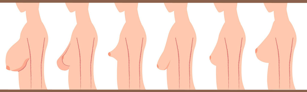 Assimetria Mamária e Seios Tuberosos: Entenda as Variações Comuns