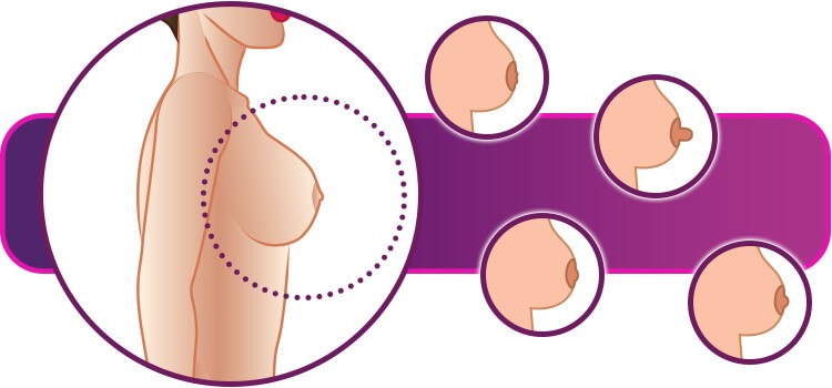 Assimetria Mamária e Seios Tuberosos: Entenda as Variações Comuns