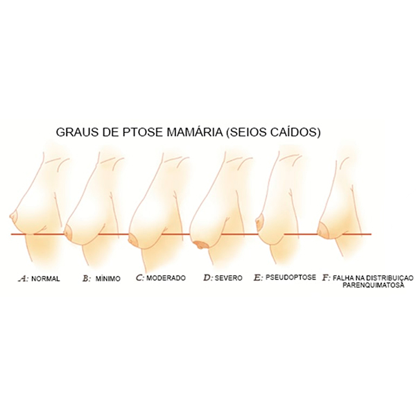 Como Escolher o Sutiã Ideal para Cada Tipo de Seio