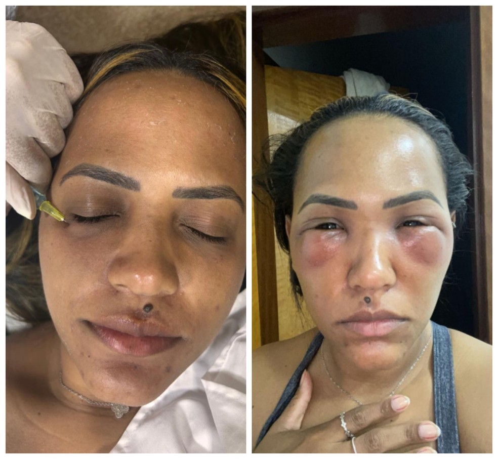 tratamentos para olheiras