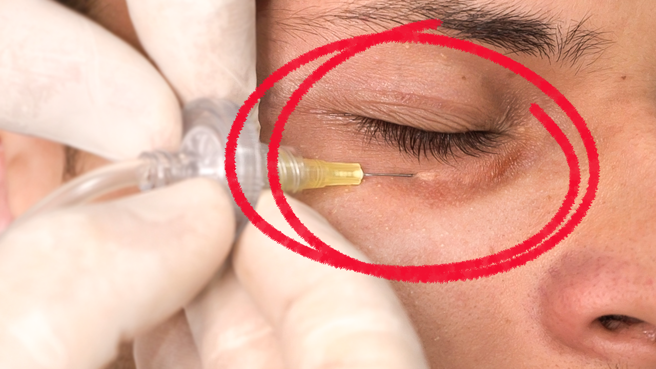 tratamentos para olheiras