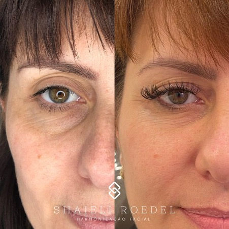 5 ideias de títulos:
1. Olheiras Pigmentares vs. Vasculares: Qual a Diferença e Como Tratar?
2. Ácido Hialurônico para Olheiras: O Guia Completo do Preenchimento
3. Rotina de Skincare para Olheiras: Cremes e Ativos Essenciais
4. Dicas Caseiras Infalíveis para Reduzir Olheiras e Bolsas
5. Blefaroplastia: A Solução Definitiva para Bolsas de Gordura sob os Olhos?