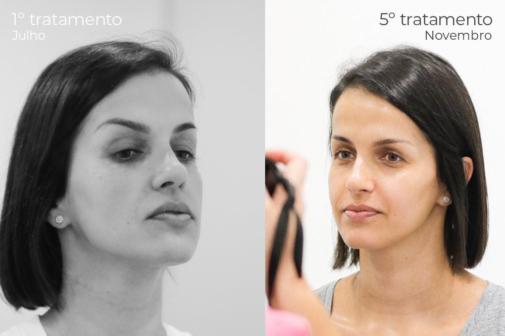 tratamentos para olheiras