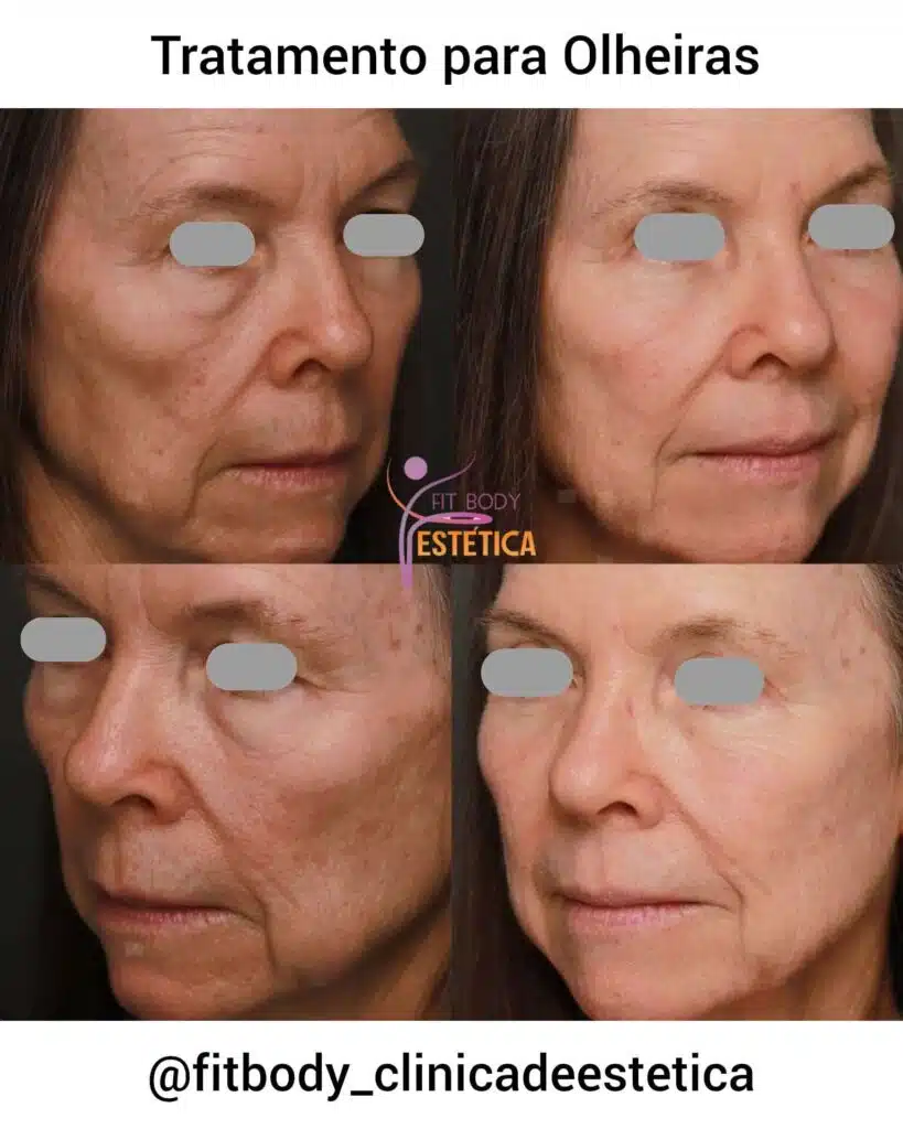 tratamentos para olheiras