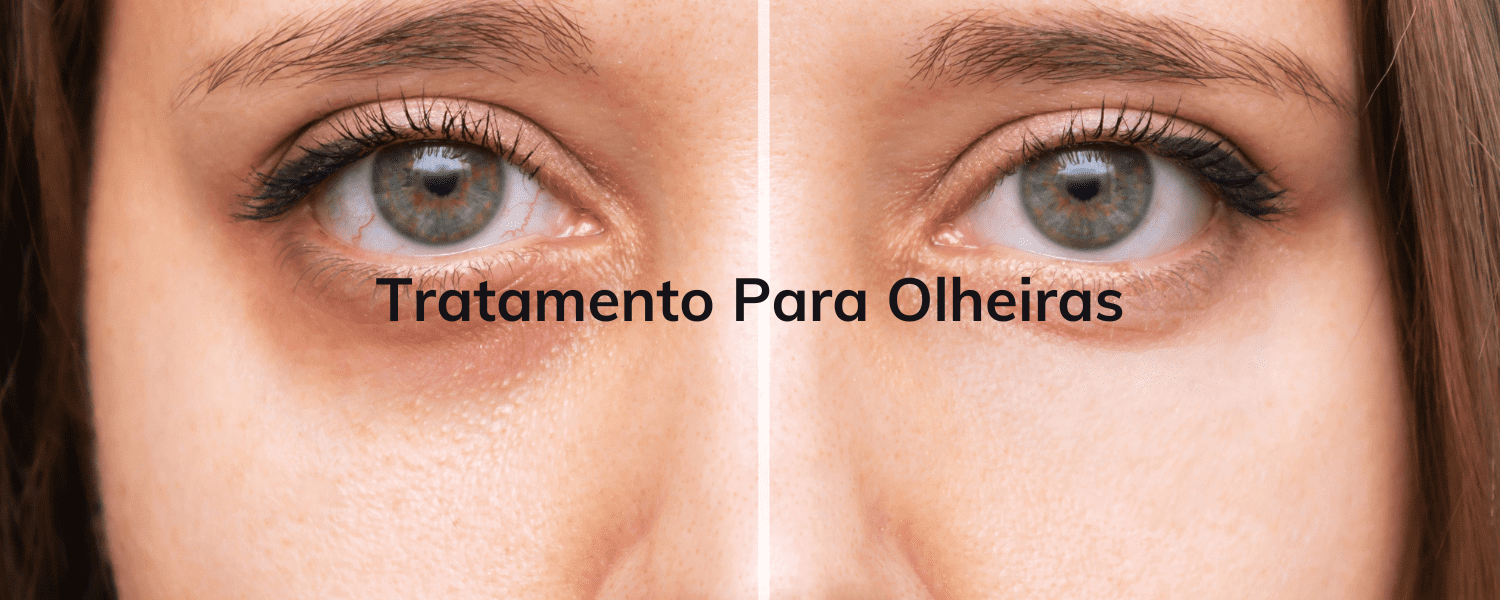 tratamentos para olheiras