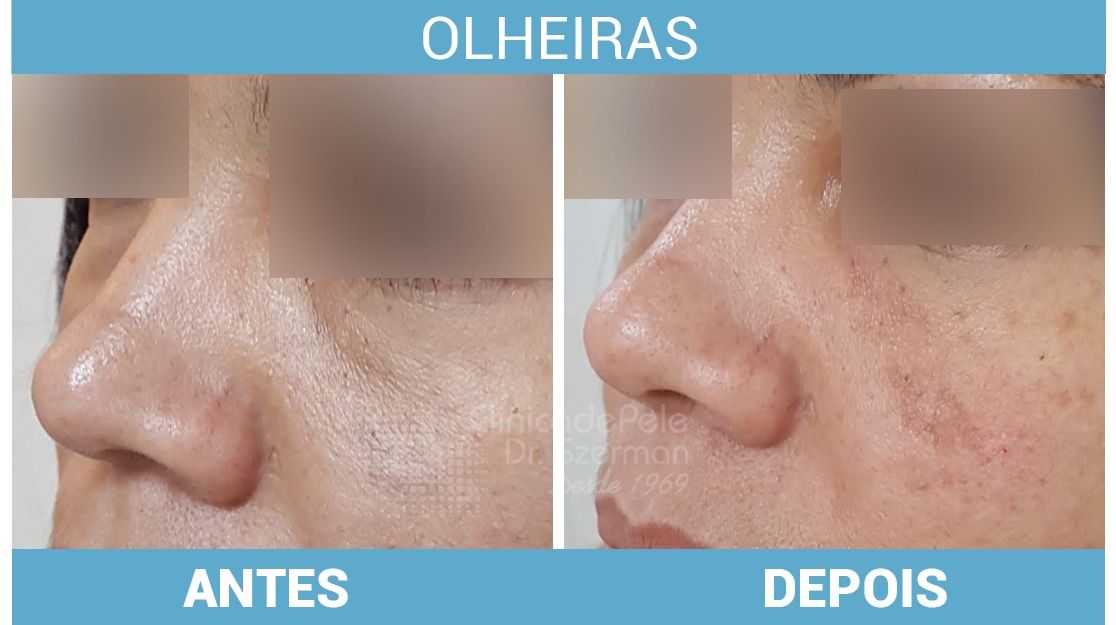 5 ideias de títulos:
1. Olheiras Pigmentares vs. Vasculares: Qual a Diferença e Como Tratar?
2. Ácido Hialurônico para Olheiras: O Guia Completo do Preenchimento
3. Rotina de Skincare para Olheiras: Cremes e Ativos Essenciais
4. Dicas Caseiras Infalíveis para Reduzir Olheiras e Bolsas
5. Blefaroplastia: A Solução Definitiva para Bolsas de Gordura sob os Olhos?