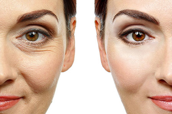 tratamentos para olheiras