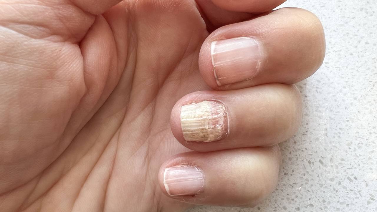 Doenças que Podem Causar Unhas Ásperas: Quando Procurar um Médico