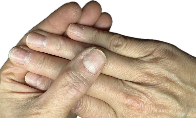 Quando Procurar um Dermatologista por Alterações nas Unhas