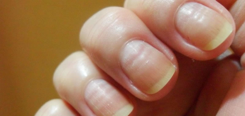 Quando Procurar um Dermatologista por Alterações nas Unhas
