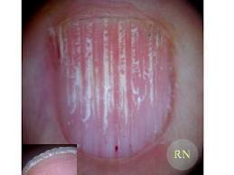 unhas com estrias verticais