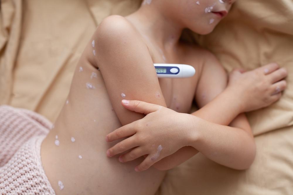 O Que Esperar Após a Vacina da Catapora: Reações e Cuidados