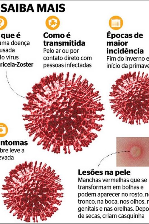 vacina contra catapora
