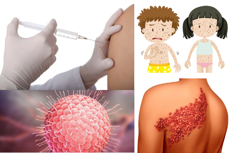 Diferenças entre a Vacina da Catapora no SUS e na Rede Particular