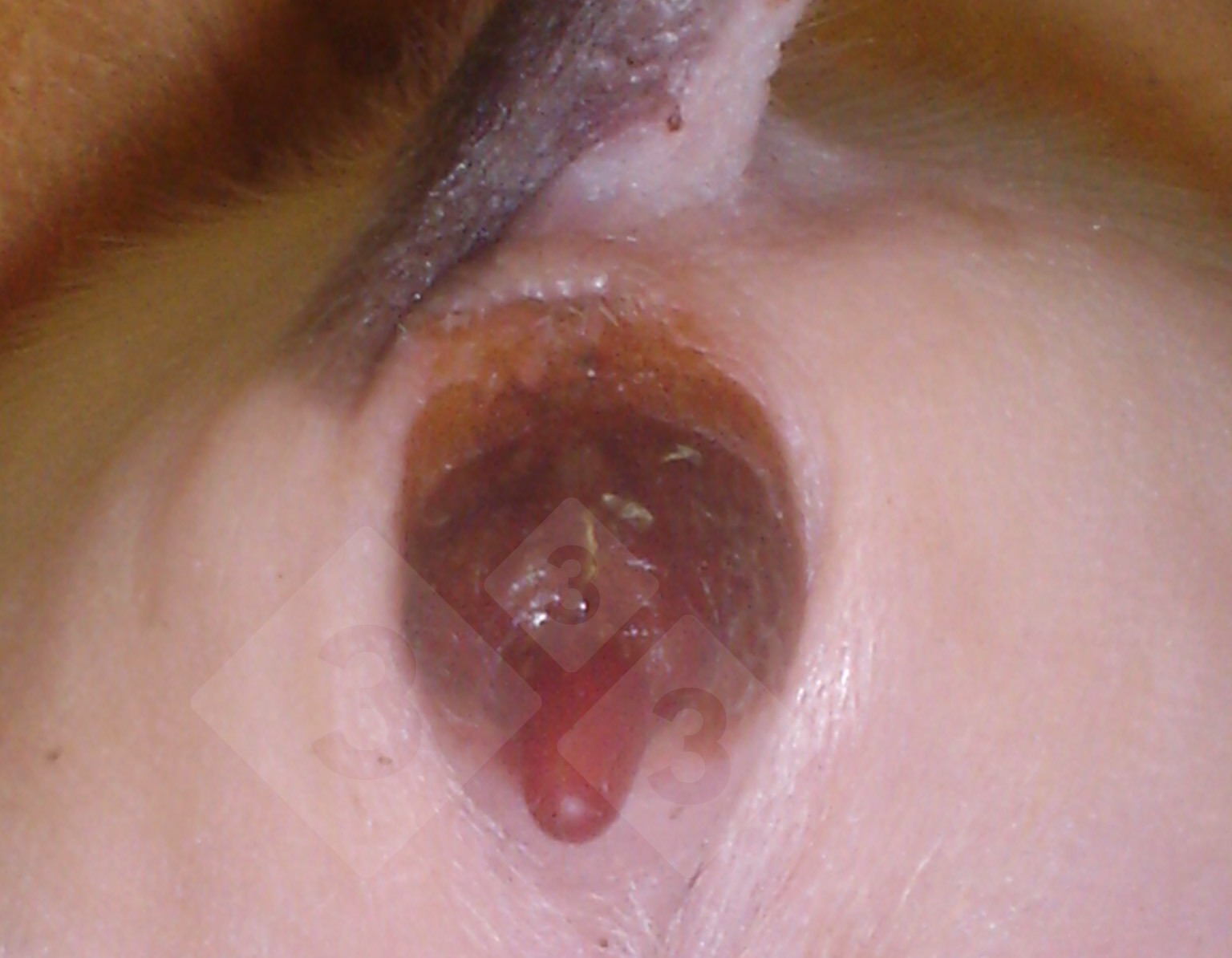 1. Vulvovaginite em Crianças: Causas