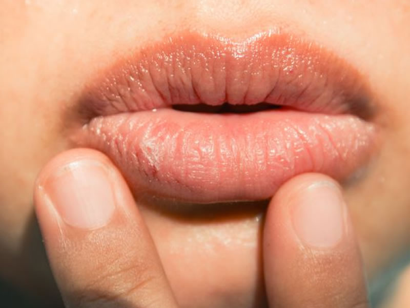 leucoplasia oral sintomas