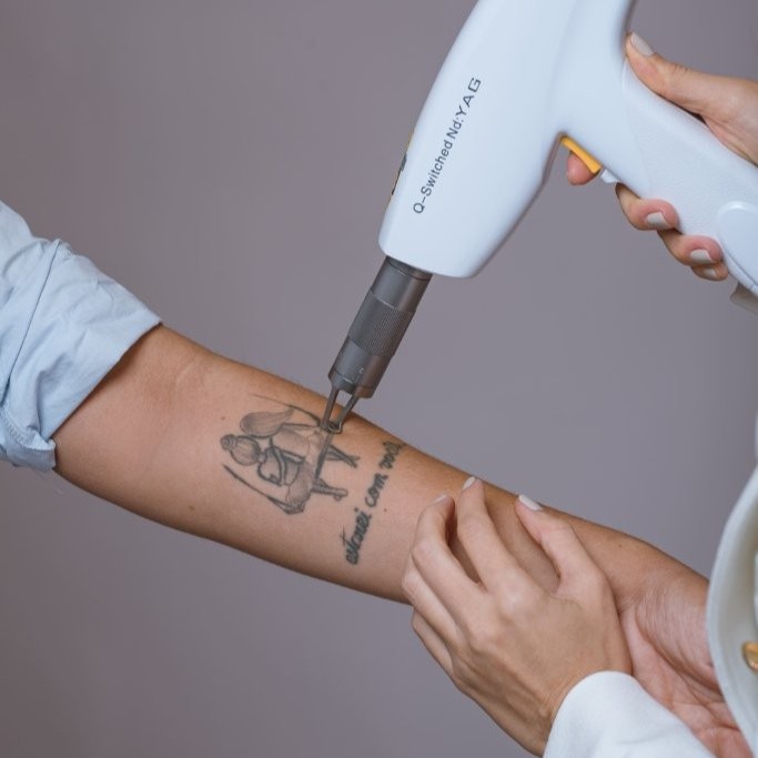 valor por sessão remoção tatuagem