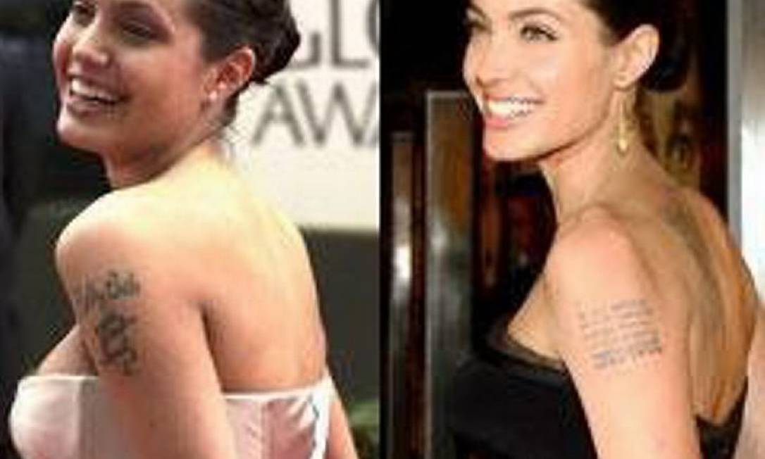 remoção de tatuagem quantas sessões