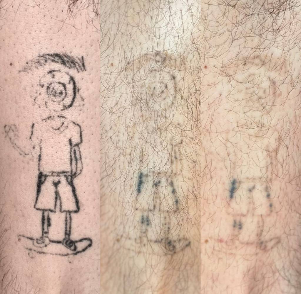 custo remoção tatuagem pequena