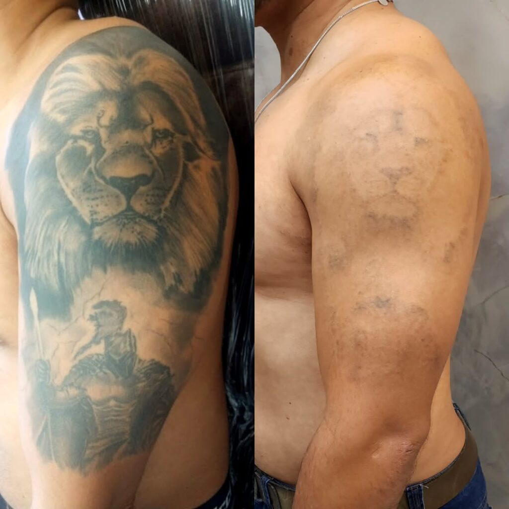 riscos tatuagem menor